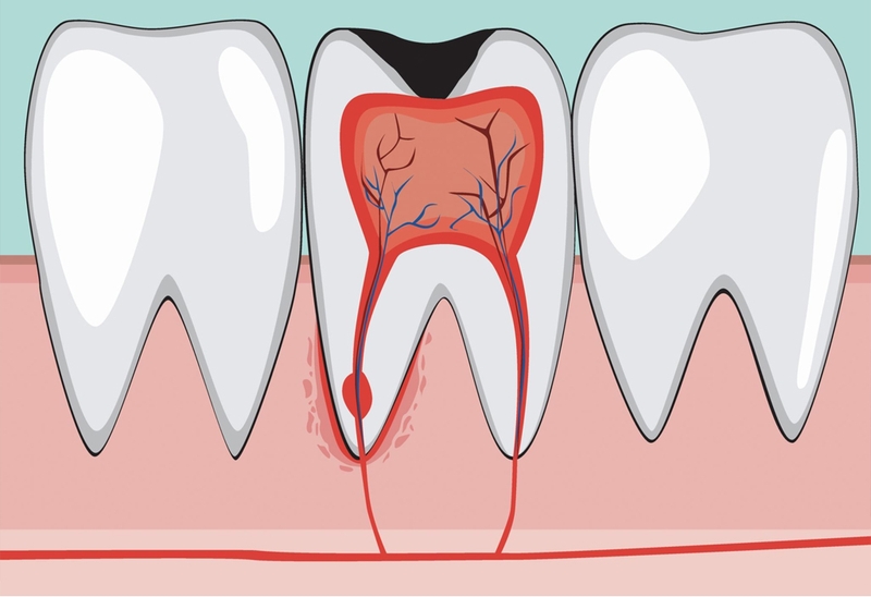 Giải đáp thắc mắc: Lấy tủy răng có ảnh hưởng đến thai nhi không 1
