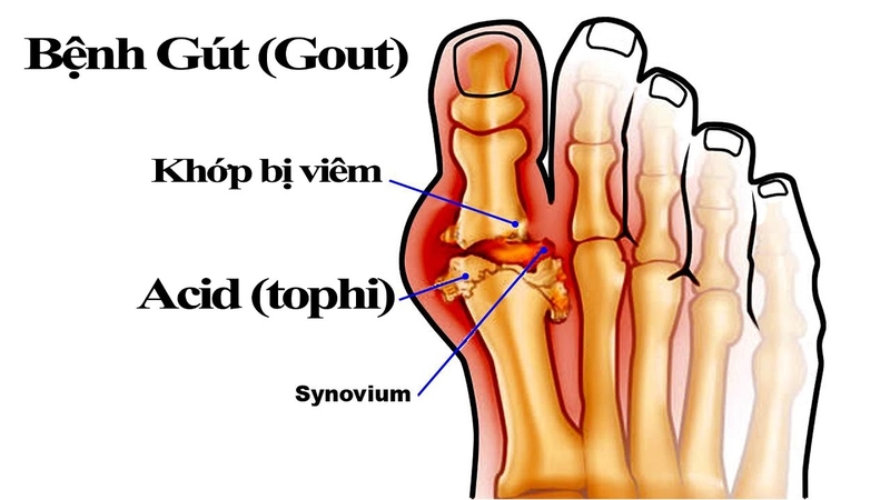 bệnh gout có chữa được không? 2