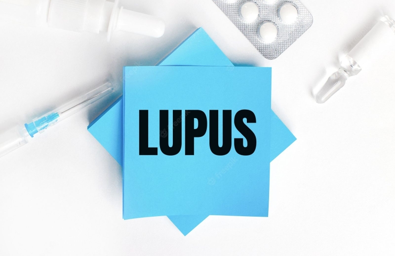 Giải đáp thắc mắc: Lupus ban đỏ hệ thống có mấy giai đoạn? 1