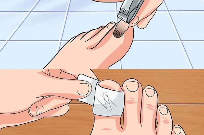 móng chân bị bật có mọc lại được không? Câu trả lời là có