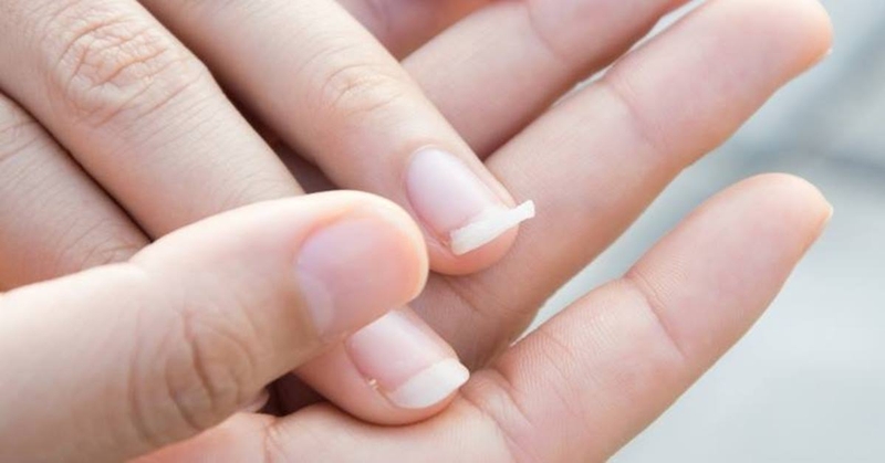 Giải đáp thắc mắc: Móng tay dễ gãy thiếu Vitamin gì? 2