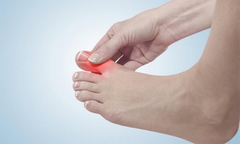 Bệnh cước chân là gì? Bị cước chân nên bôi thuốc gì cho bàn chân?