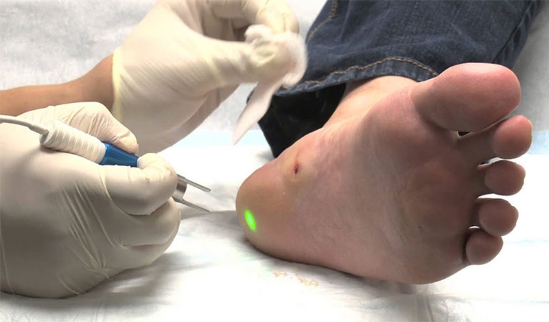 Đốt laser là một trong những phương pháp loại bỏ mụn cóc hiệu quả