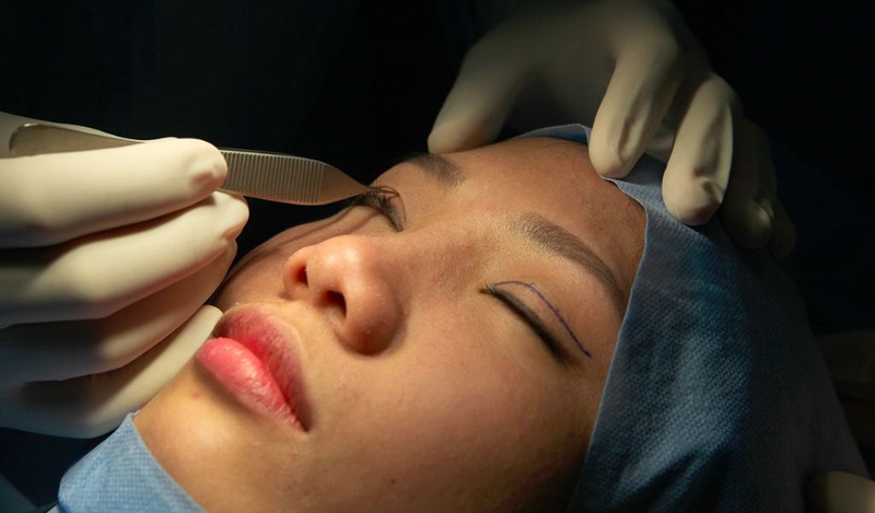 Giải đáp thắc mắc những thông tin về nhấn mí mắt bằng chỉ 3