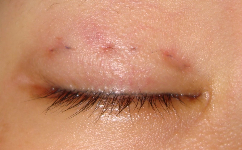 Giải đáp thắc mắc những thông tin về nhấn mí mắt bằng chỉ 1