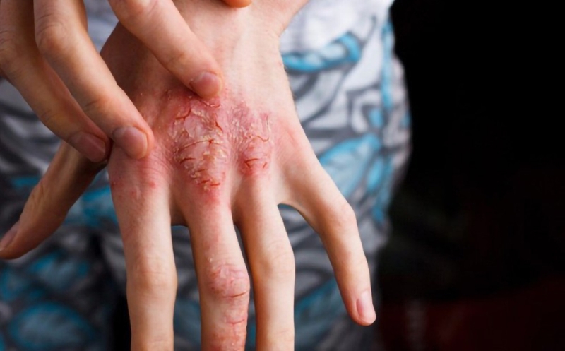 Người nhiễm sán lá gan nhỏ thông qua việc uống nước lã, ăn cá sống hoặc nấu chưa chín