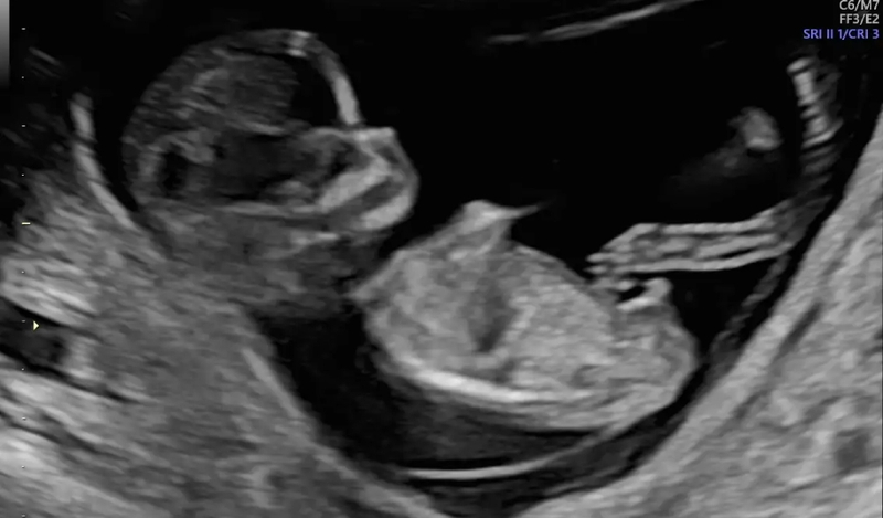 Giải đáp thắc mắc: Siêu âm 12 tuần đã biết trai hay gái chưa 2