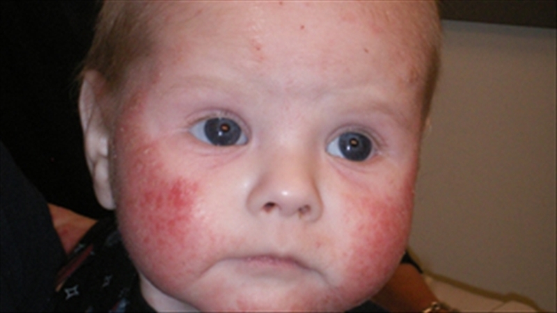 sudocrem có bôi nẻ được không