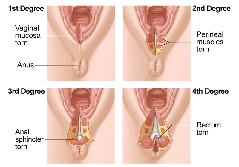 Giải đáp thắc mắc: Tầng sinh môn bị rách có sao không?1