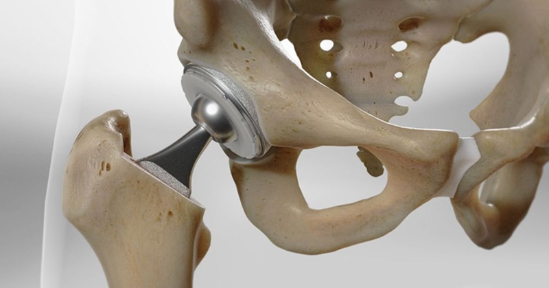 giai-dap-thac-mac-thay-khop-hang-bao-hiem-chi-tra-bao-nhieu 2.jpg