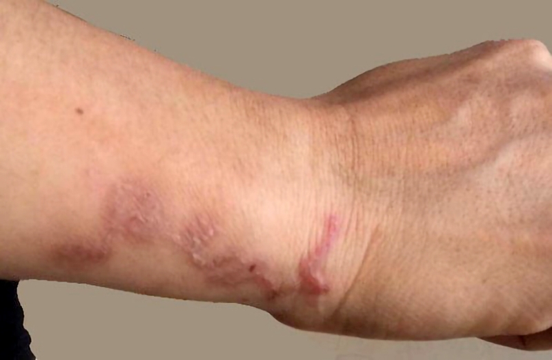 Bạn có thể bị bệnh sán lợn gạo nếu ăn phải tiết canh của lợn nhiễm loại sán này