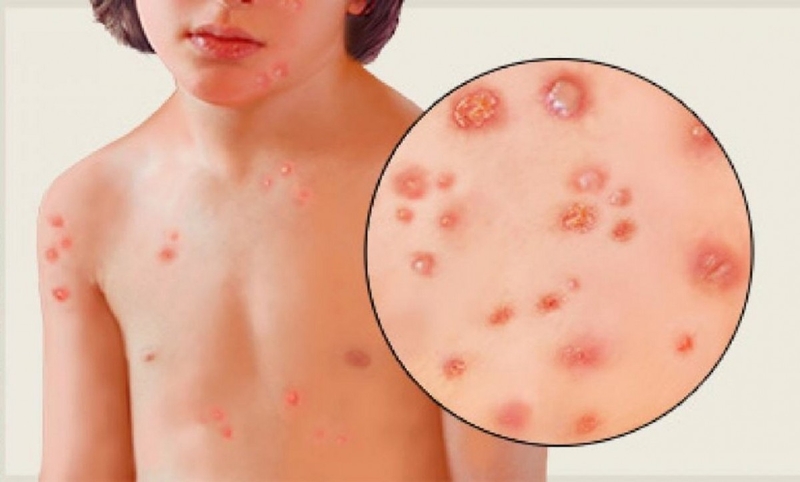Giải đáp thắc mắc: Trẻ bị bệnh thủy đậu có được tắm không? 2