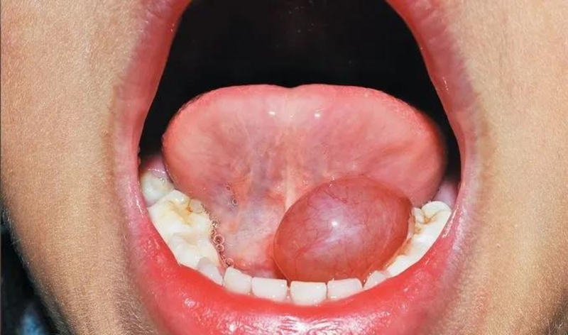 Giải đáp thắc mắc: U nang dưới lưỡi có nguy hiểm không? 1