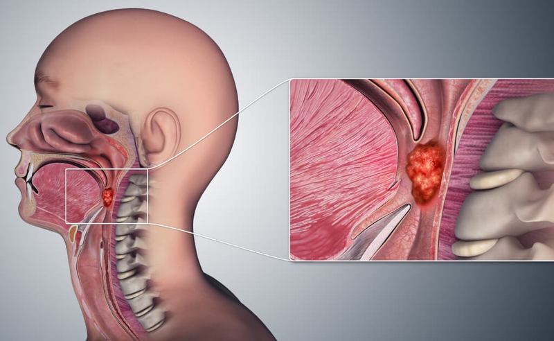 Giải đáp thắc mắc: Ung thư vòm họng thường gặp ở độ tuổi nào? 2