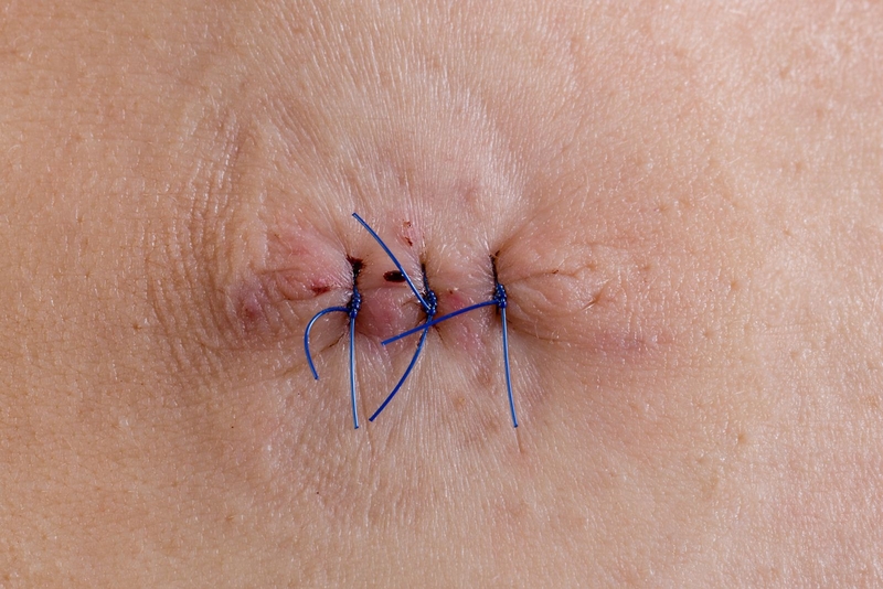 Giải đáp thắc mắc: Vết khâu tầng sinh môn bị nổi cục là do đâu?1