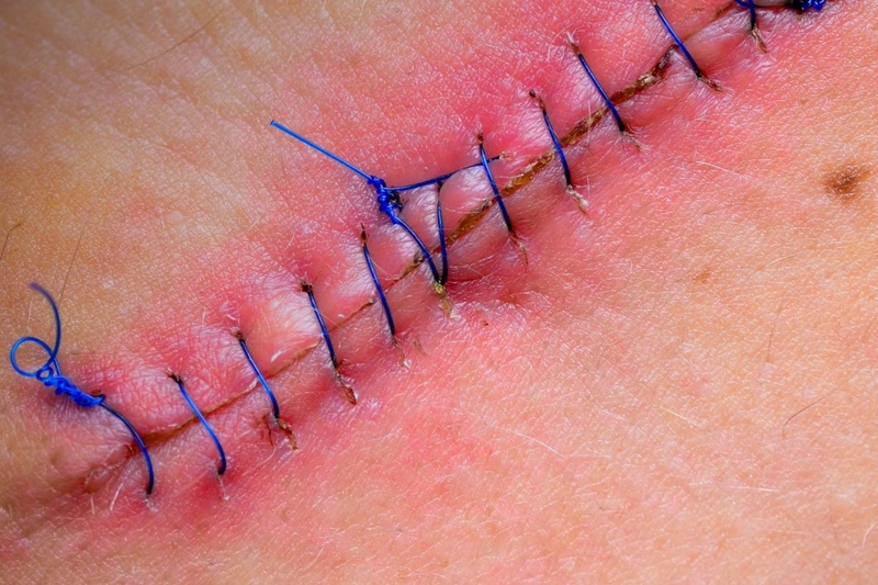 Giải đáp thắc mắc: Vết rạch tầng sinh môn bị mưng mủ là do đâu?2