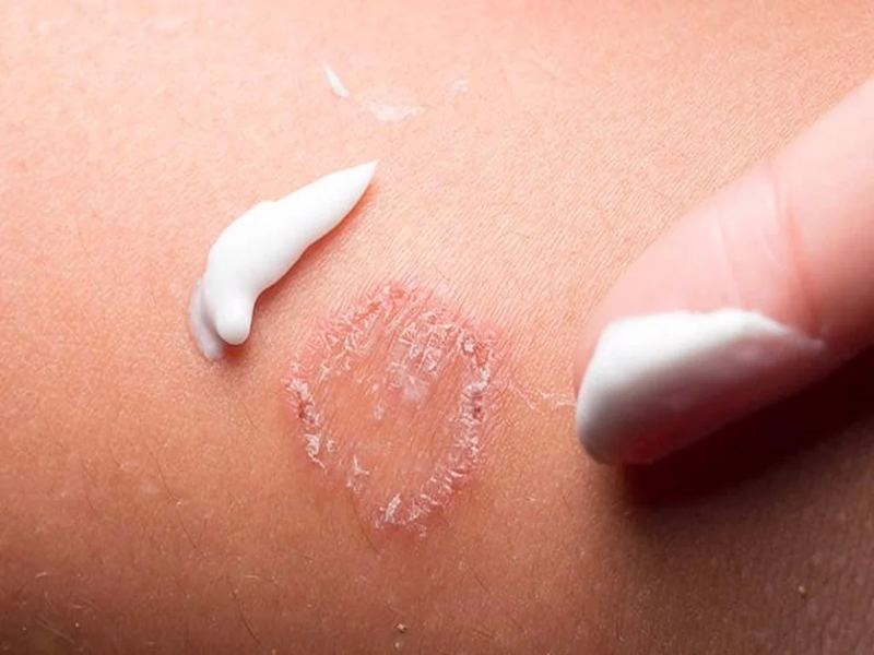 Giải đáp thắc mắc: Viêm da tiếp xúc bao lâu thì khỏi? 4