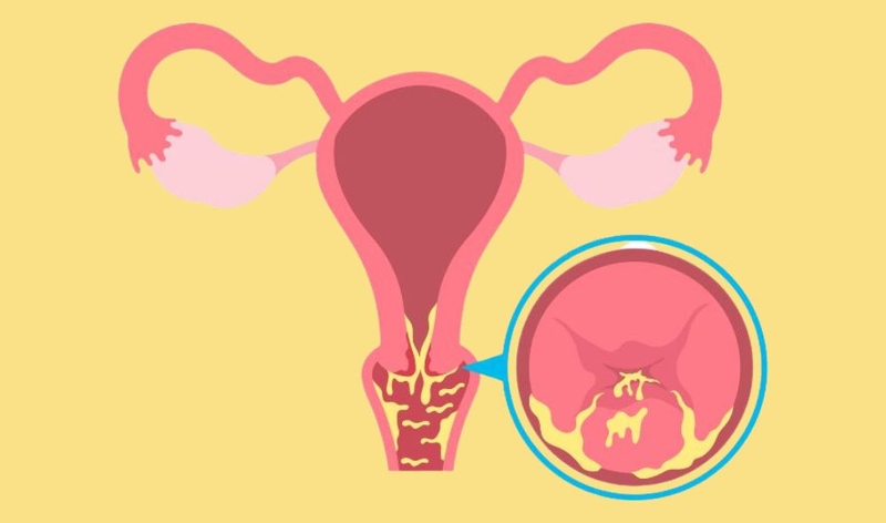 Giải đáp thắc mắc: Viêm lộ tuyến có gây ung thư không?