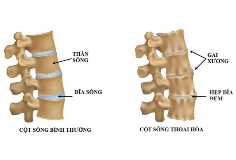 Giải đáp: Thoái hoá đốt sống cổ có mổ được không? 1