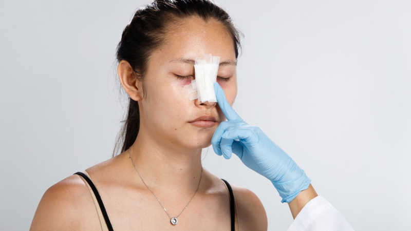Mũi có thể xuất hiện cảm giác căng tức nhẹ, vùng quanh mắt hơi bầm tím hoặc sưng.