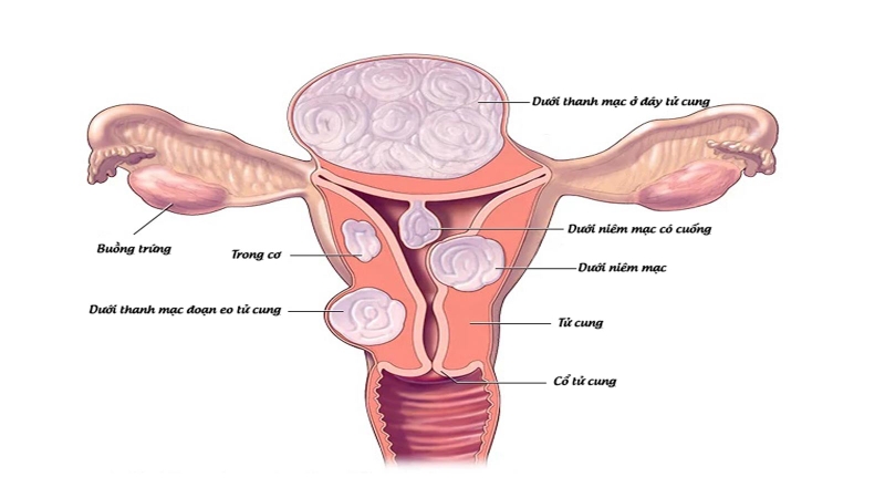 Giải đáp: U xơ tử cung có chuyển thành ung thư không? 2