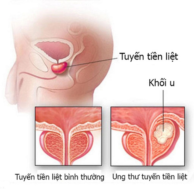 [Giải đáp] Ung thư tuyến tiền liệt có di truyền không