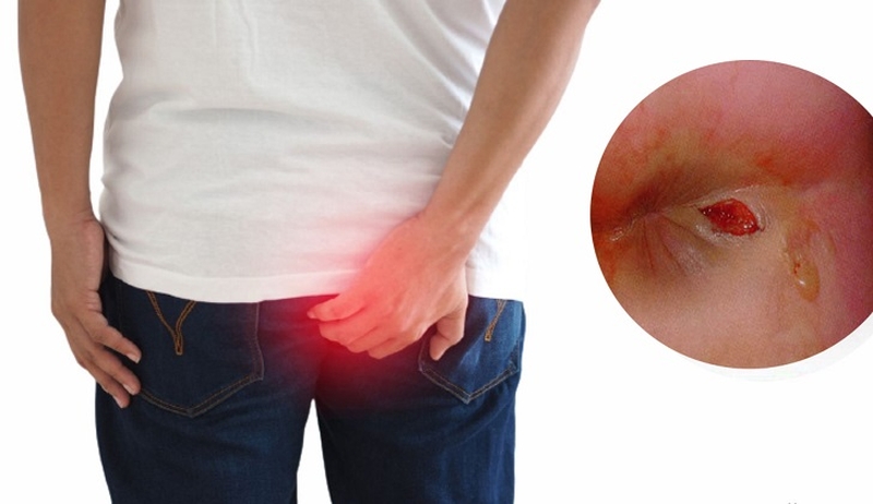 Giải đáp: Vành hậu môn có cục cứng là dấu hiệu của bệnh gì?2