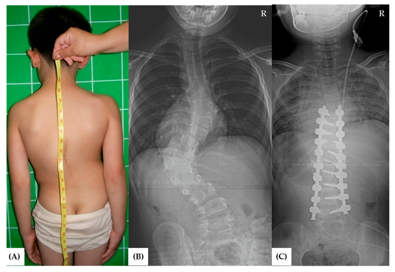 Giải đáp: Vẹo cột sống bẩm sinh là gì? 1
