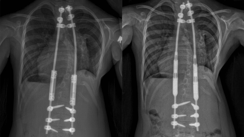 Giải đáp: Vẹo cột sống bẩm sinh là gì? 4