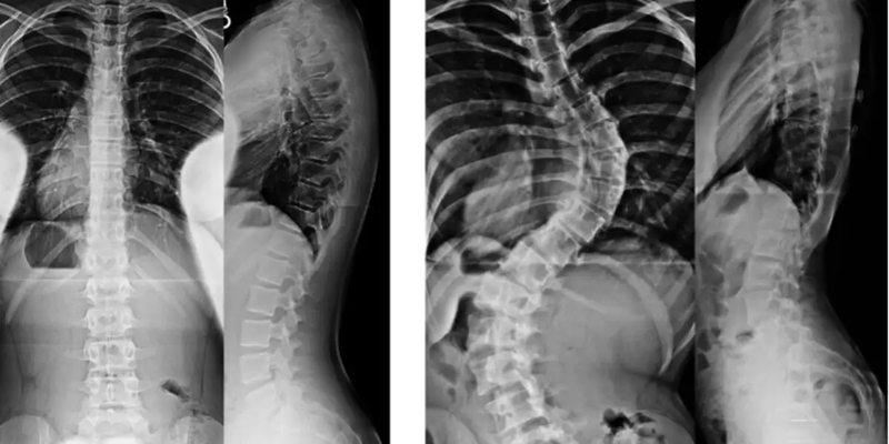 Giải đáp: Vẹo cột sống bẩm sinh là gì? 2