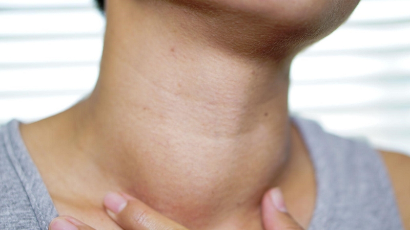 Giải đáp vì sao thiếu iot gây ra bướu cổ? 3