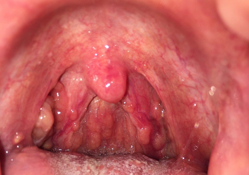 Giải đáp: Viêm họng hạt có gây hôi miệng không?