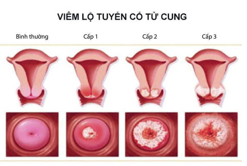 Giải đáp: Viêm lộ tuyến cổ tử cung 1cm nặng hay nhẹ? 1
