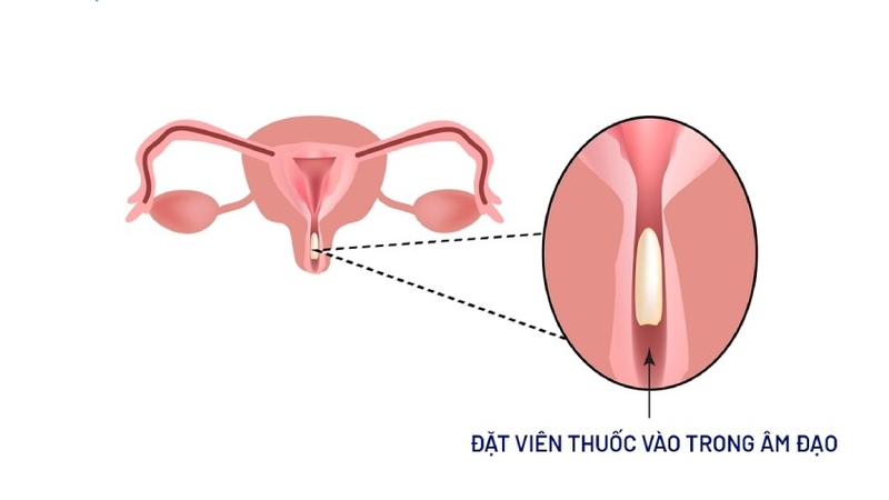 Giải đáp: Viêm lộ tuyến cổ tử cung 1cm nặng hay nhẹ? 4