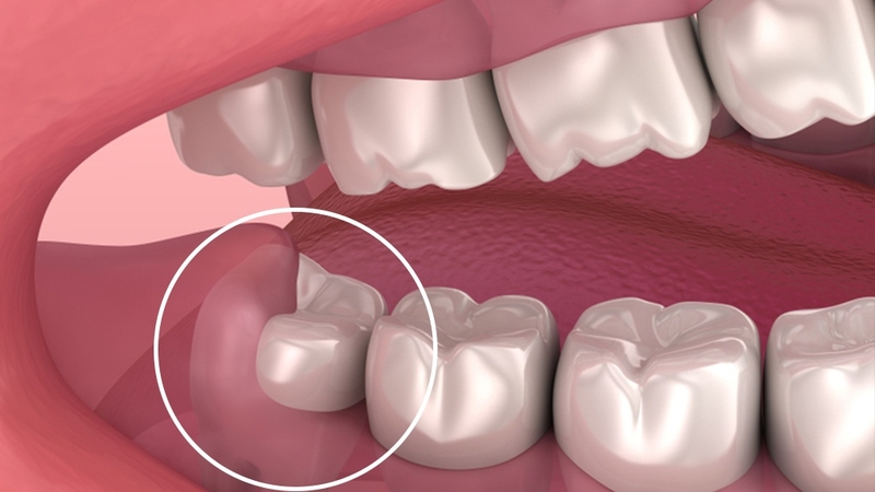 giai-dap-viem-loi-trum-co-tu-khoi-duoc-khong 3.jpg