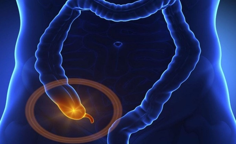 Giải đáp: Viêm ruột thừa nhẹ có cần mổ không? 1