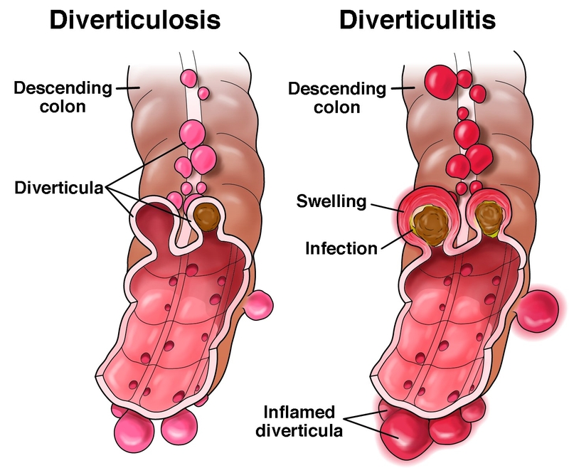 Giải đáp: Viêm túi thừa đại tràng kiêng ăn gì? 2