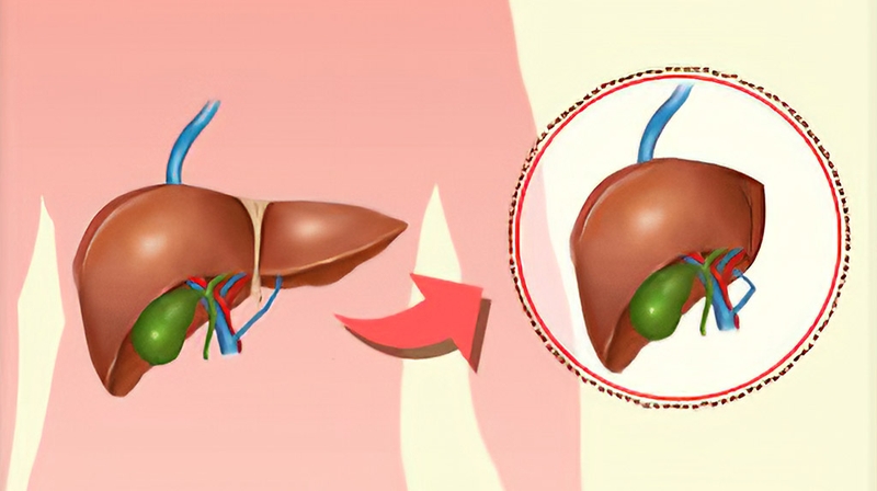 Giải đáp: Xơ gan có chữa được không? Cách điều trị xơ gan là gì? 4
