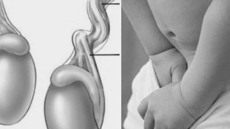 Giải đáp: Xoắn tinh hoàn có tự khỏi không?