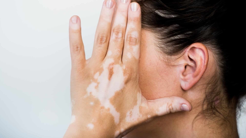 Bệnh bạch biến có thể điều trị bằng nhiều phương pháp khác nhau