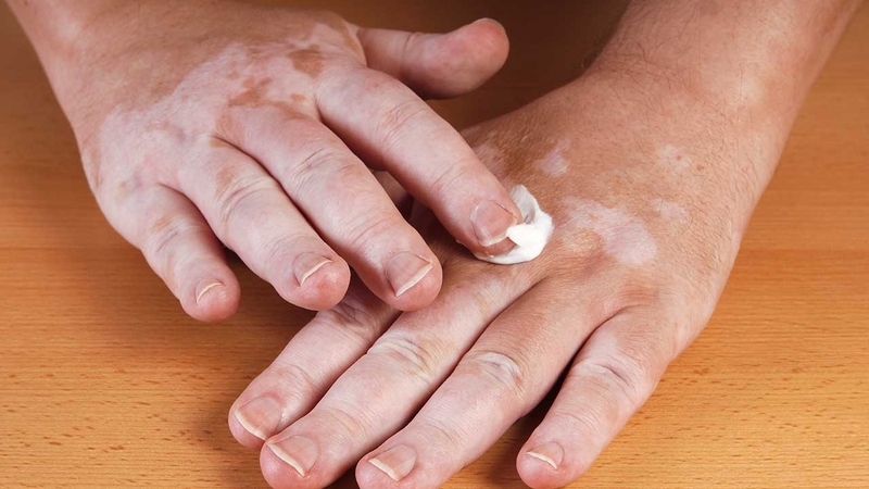 Bệnh bạch biến hoàn toàn không lây nhiễm chéo