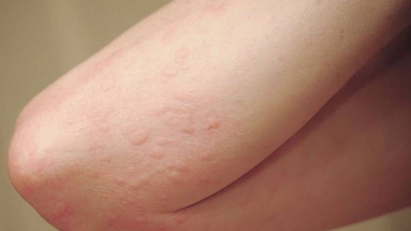 Giai đoạn cửa sổ HIV là gì? Cách phòng và điều trị bệnh HIV hiệu quả 2