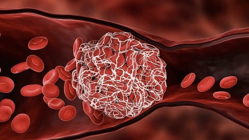 giai-ma-bi-an-ve-u-cuon-canh-nguyen-nhan-trieu-chung-va-cach-dieu-tri 4