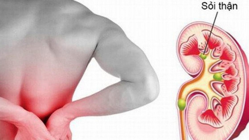 Giải mã sự hình thành sỏi thận và nguyên nhân gây bệnh sỏi thận 1