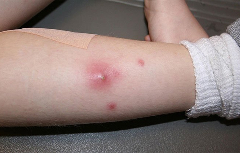 Giải pháp điều trị nóng trong người hiệu quả 1