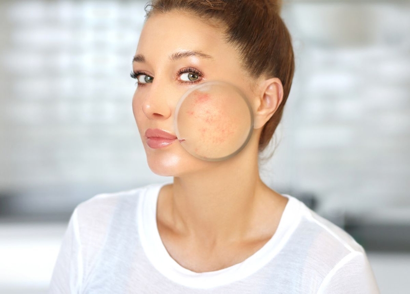 giải pháp nào cho người đốt tàn nhang bị sẹo lõm 1