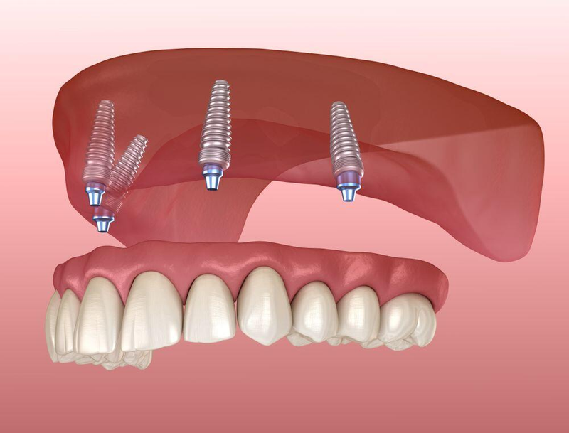 Giải pháp phục hình răng implant all in 4: ưu và nhược điểm 3