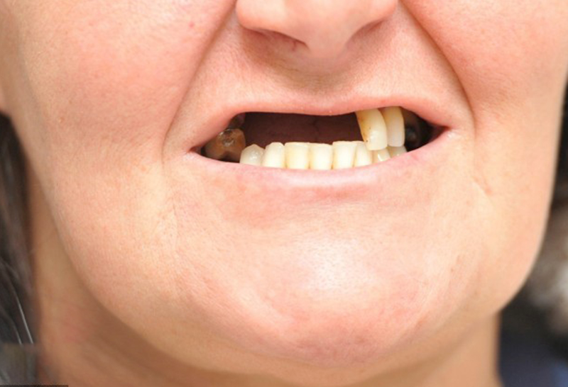 Giải pháp phục hình răng implant all in 4: ưu và nhược điểm 1