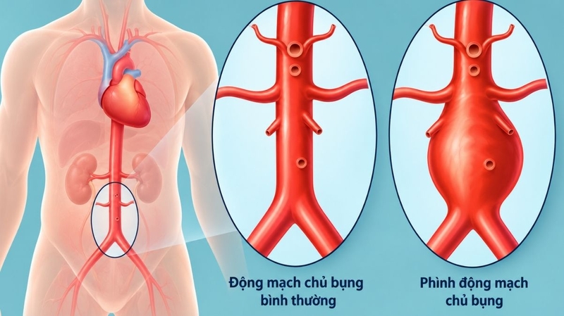 Bóc tách động mạch chủ có thể ảnh hưởng tưới máu các cơ quan