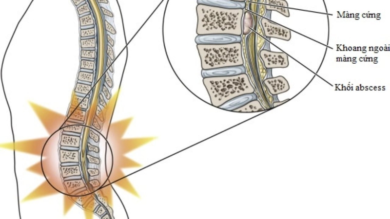Giải phẫu khoang ngoài màng cứng và các ứng dụng lâm sàng 1